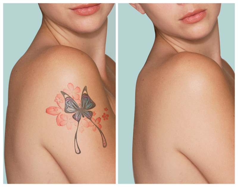 Come rimuovere i tatuaggi temporanei 