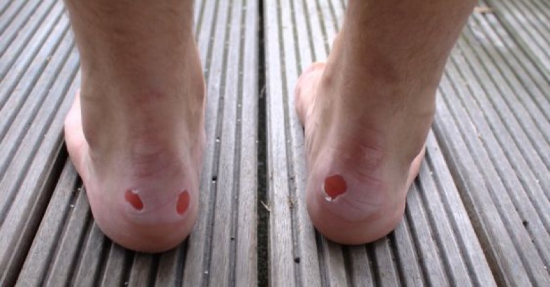 cliomakeup-come-evitare-vesciche-ai-piedi-16