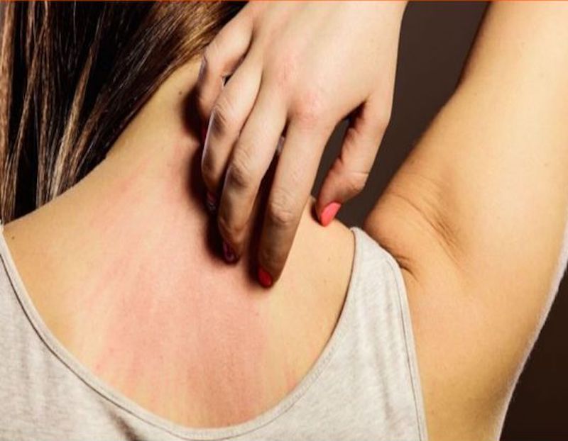 cliomakeup-irritazione-da-sudore-11