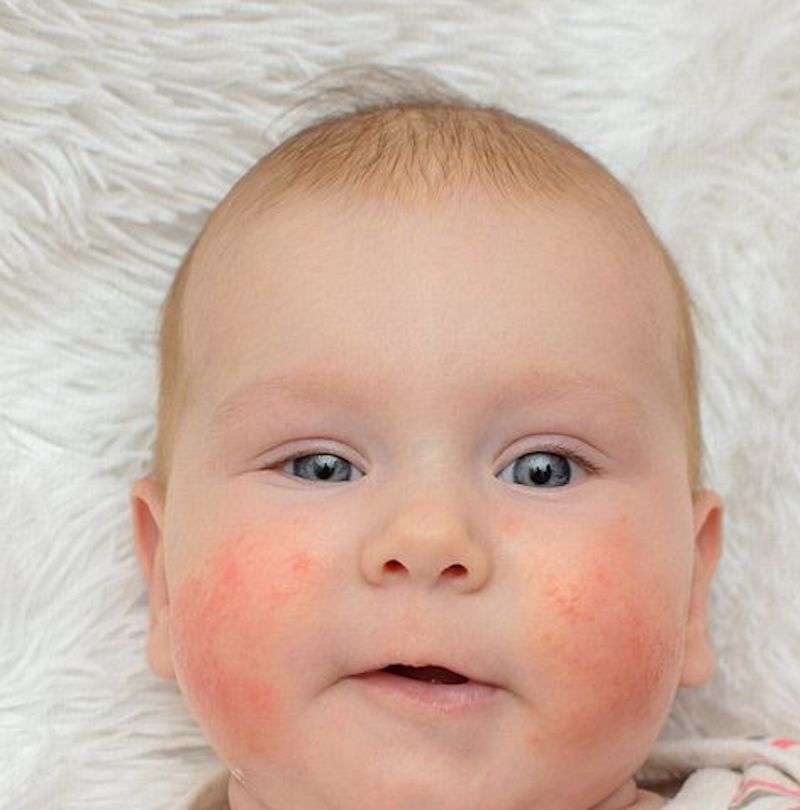 cliomakeup-irritazione-da-sudore-2