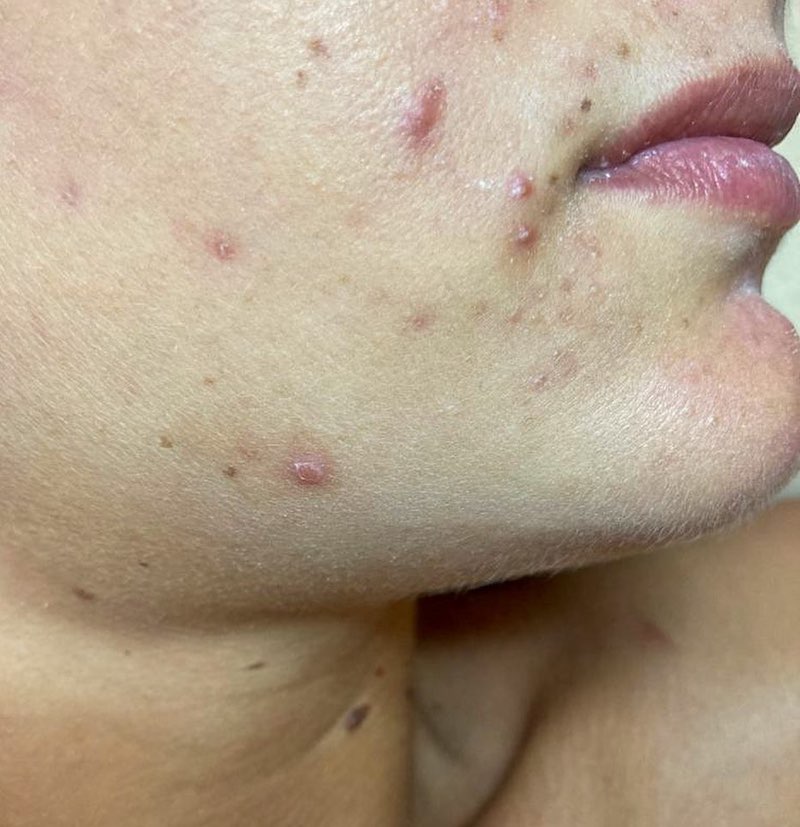 cliomakeup-acne-mascherina-teamclio-brufoli-3