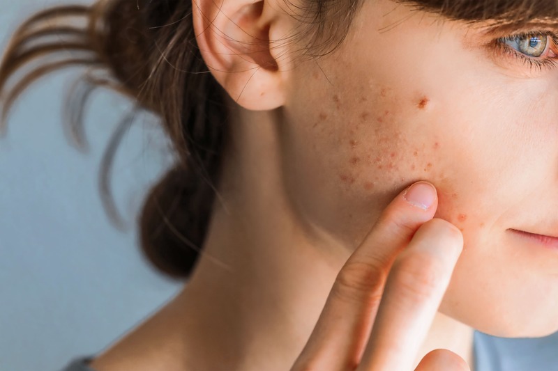 come-usare-burro-di-karite-acne
