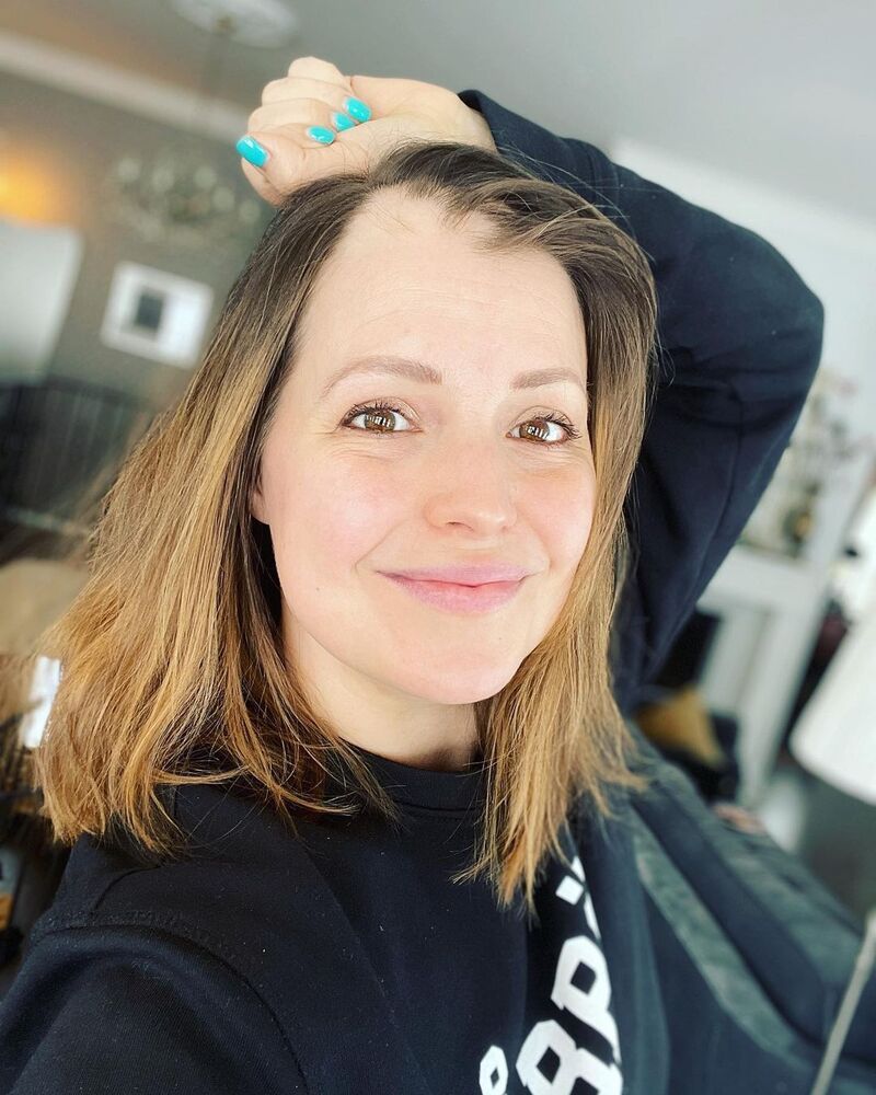 cliomakeup-alopecia-androgenetica-femminile