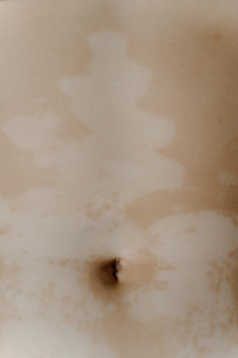 cliomakeup-vitiligine-busto