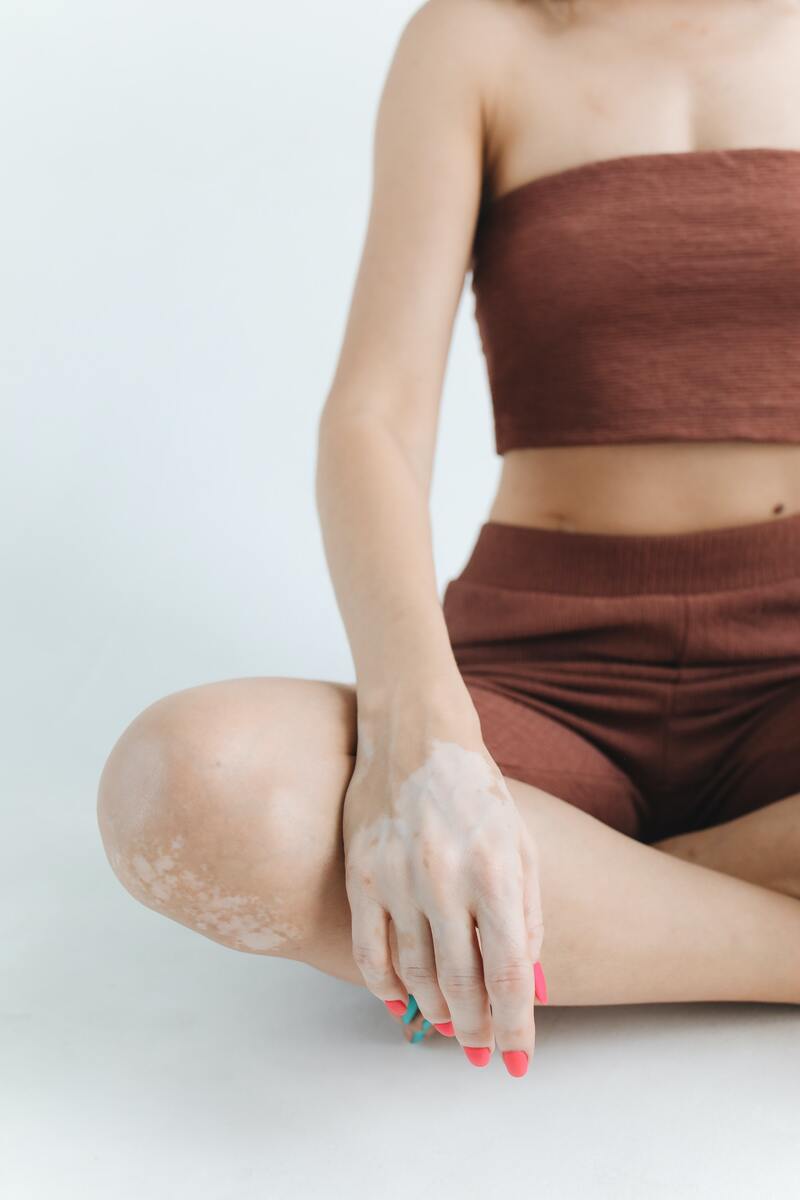 cliomakeup-vitiligine-pelle