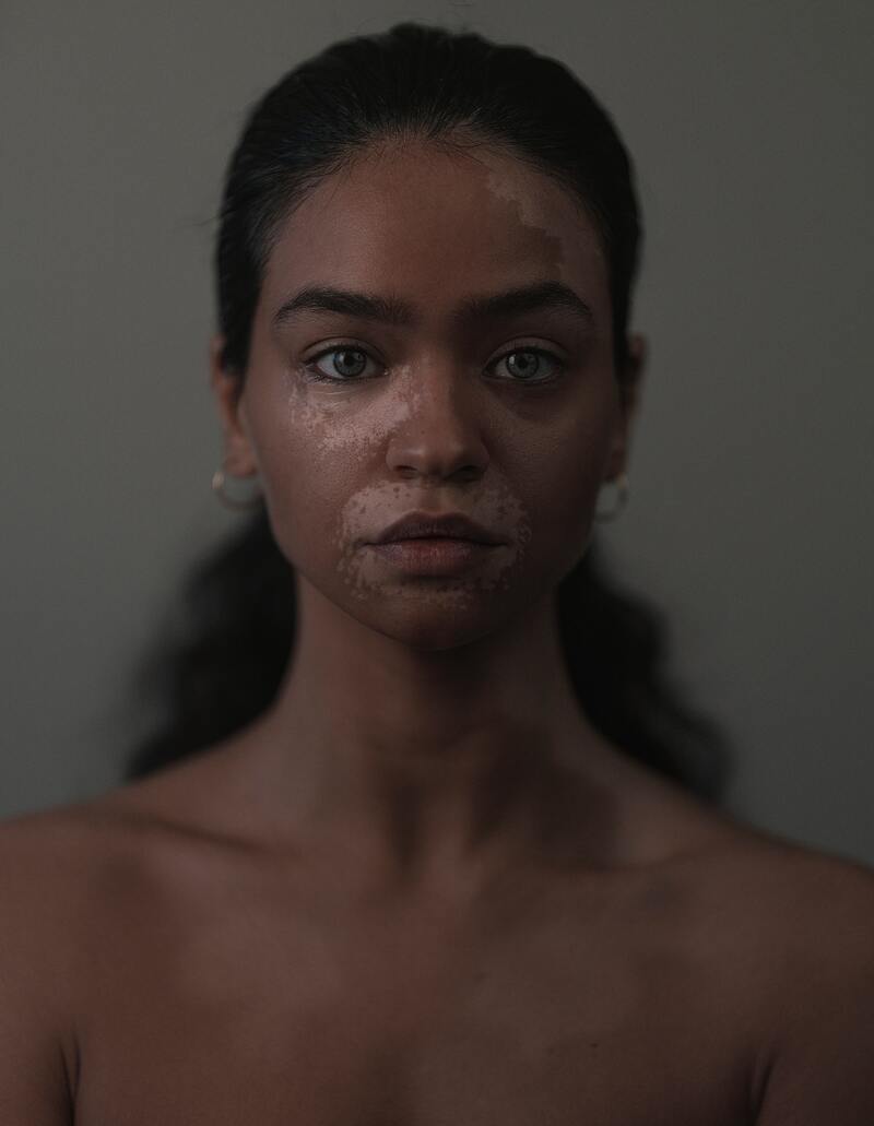 cliomakeup-vitiligine-viso