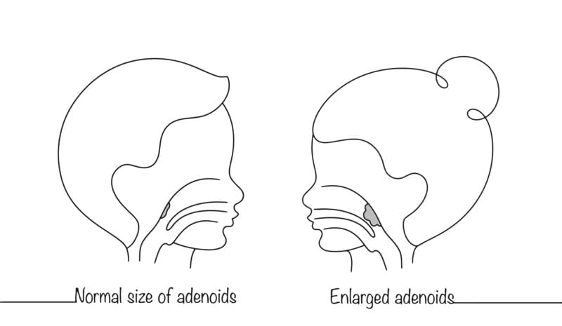 cliomakeup-adenoidi-bambini-ingrossate