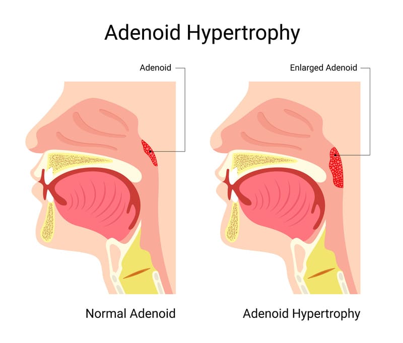 cliomakeup-adenoidi-bambini-ipertrofiche
