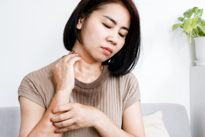 cliomakeup-dermatite-da-sudore-6