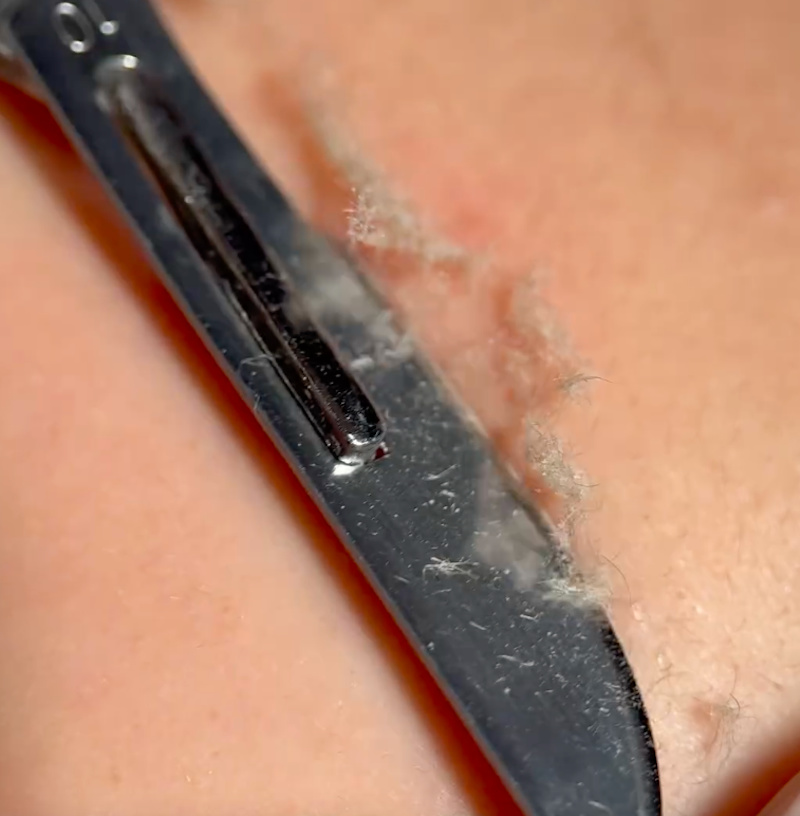 dermal-shaving-depilazione-viso