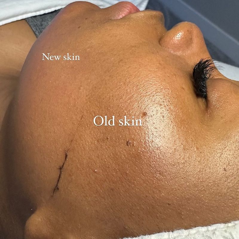 dermal-shaving-dermaplanning