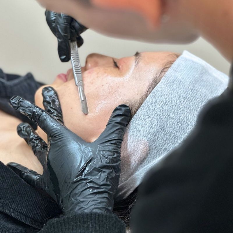 dermal-shaving-estetista