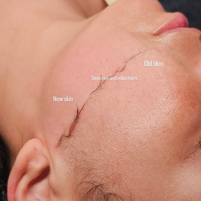 dermal-shaving-prima-dopo