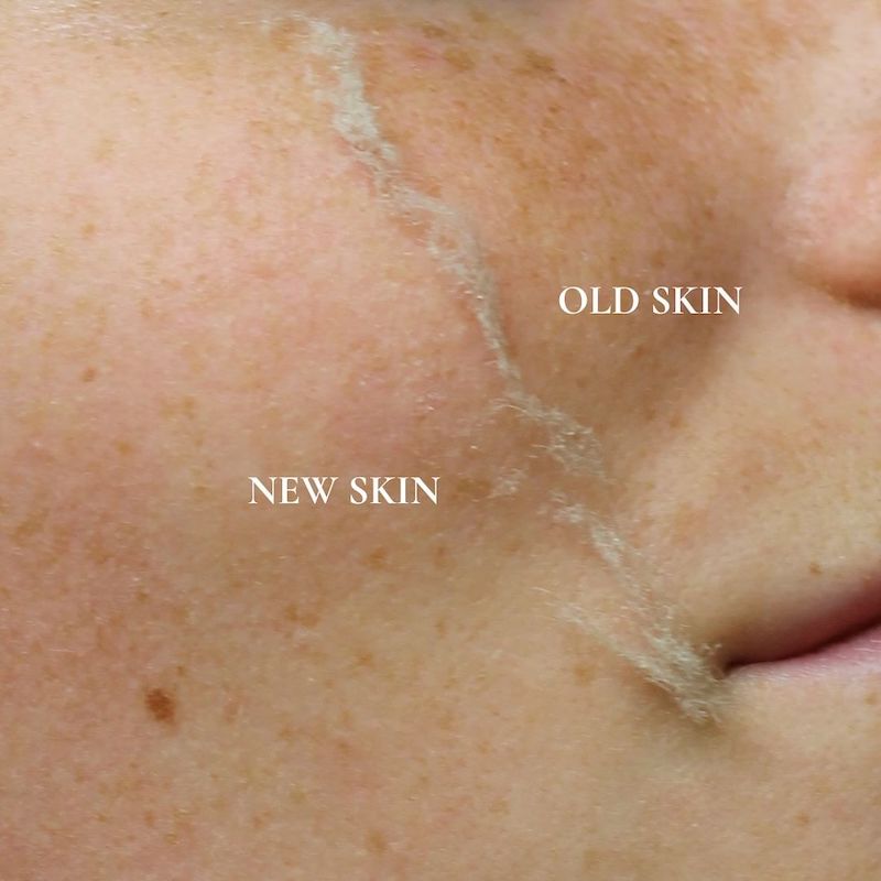 dermal-shaving-risultati