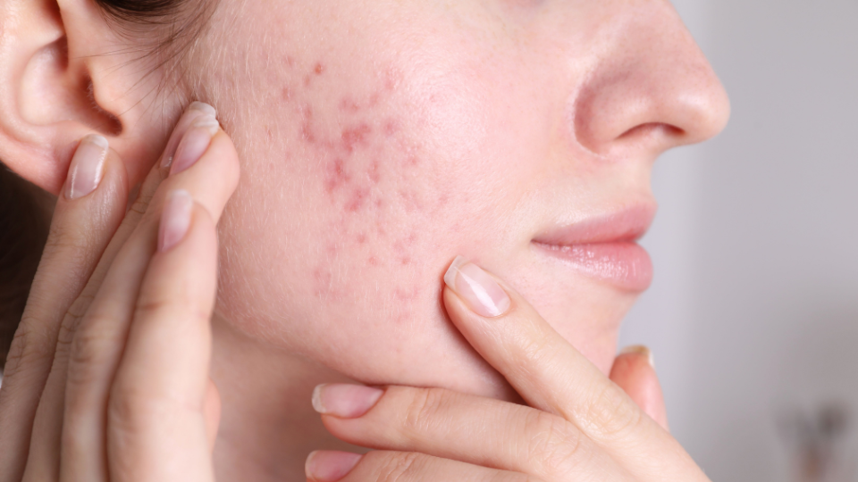 come-usare-crema-egyptian-magic-utilizzi-prodotto-cicatrici pelle