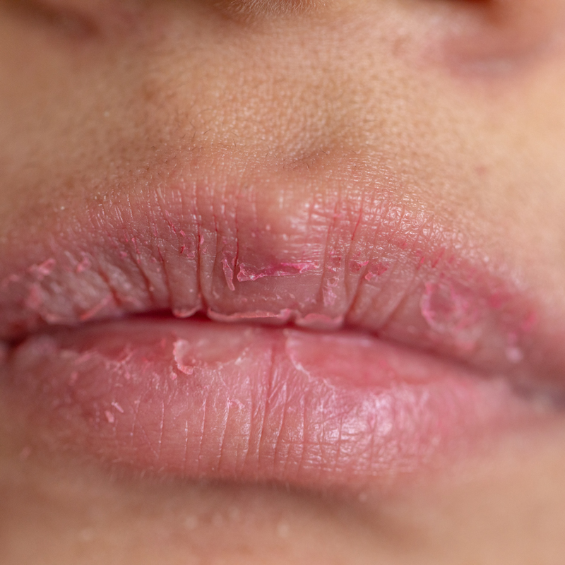 come-usare-vaselina-labbra-secche