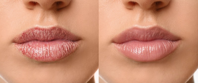 lip-oil-labbra-secche