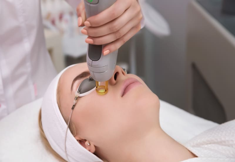 melasma-macchia-solare-laser