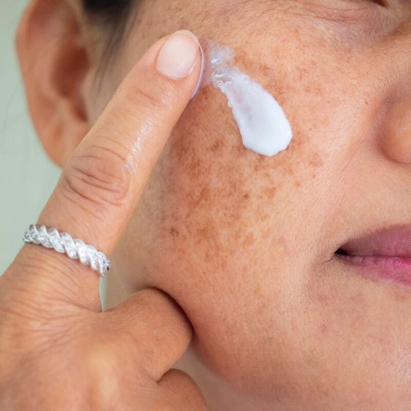 melasma-macchia-solare-trattamenti