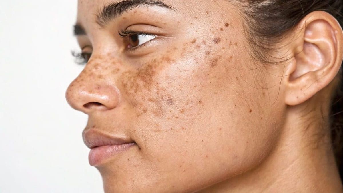melasma-macchia-solare-viso-foto