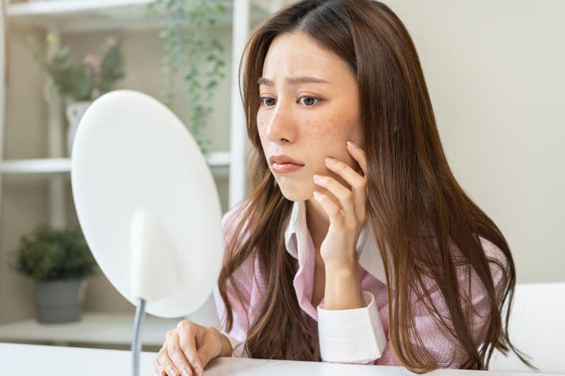 melasma-macchia-solare-viso