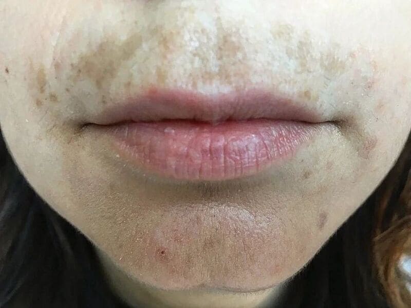 melasma-macchia-solare-zona-baffetti