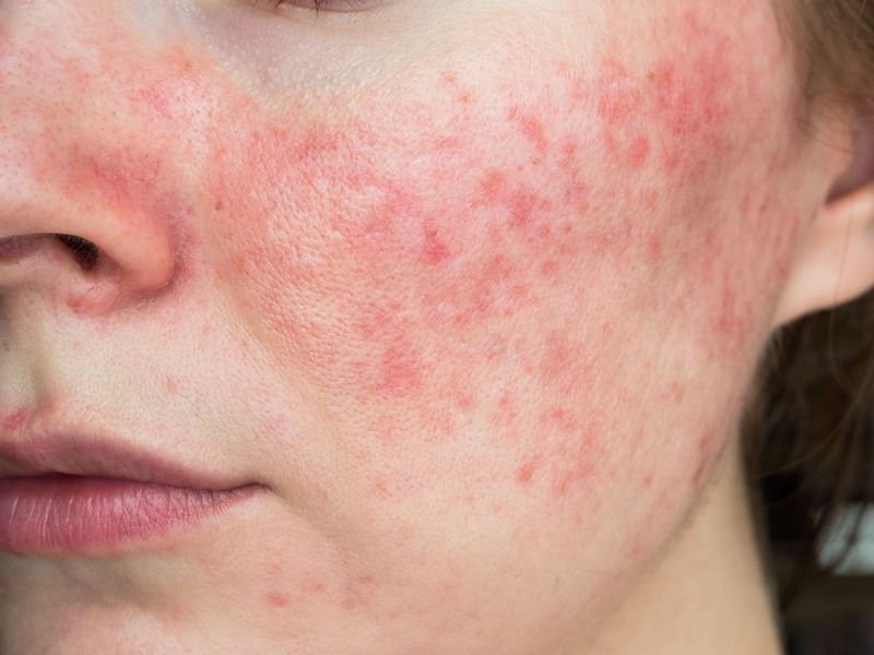 macchie-pelle-rosse-rosacea