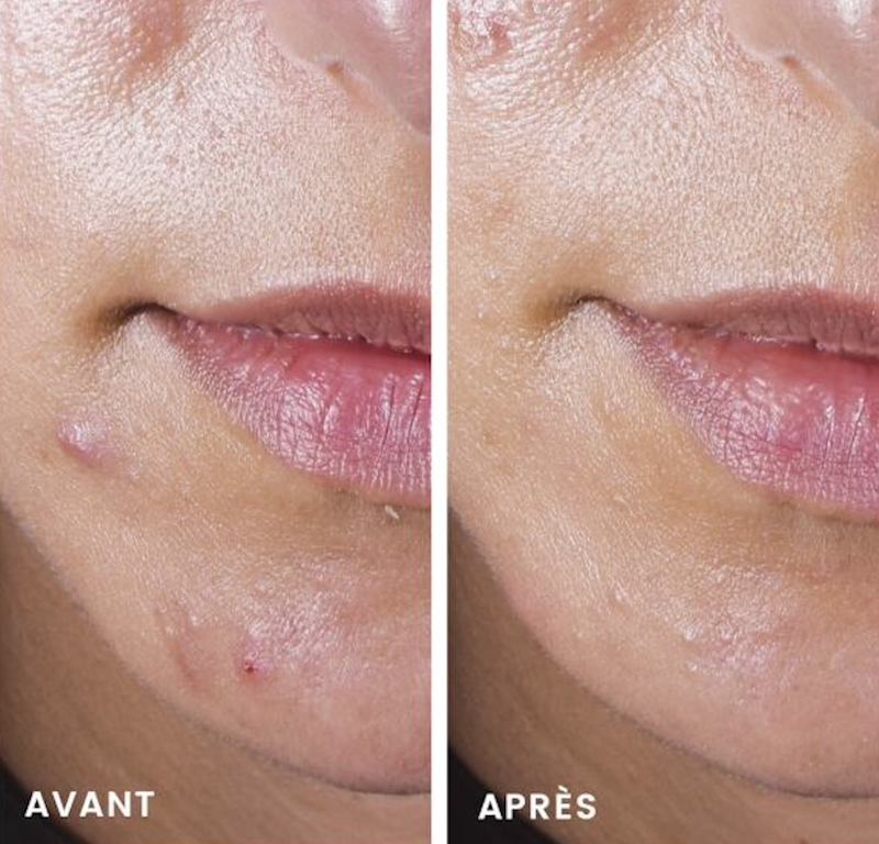 come-usare-cleanance-comedomed-avene-prima-dopo