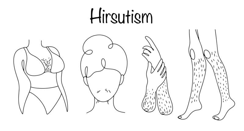 peli-sul-seno-irsutismo