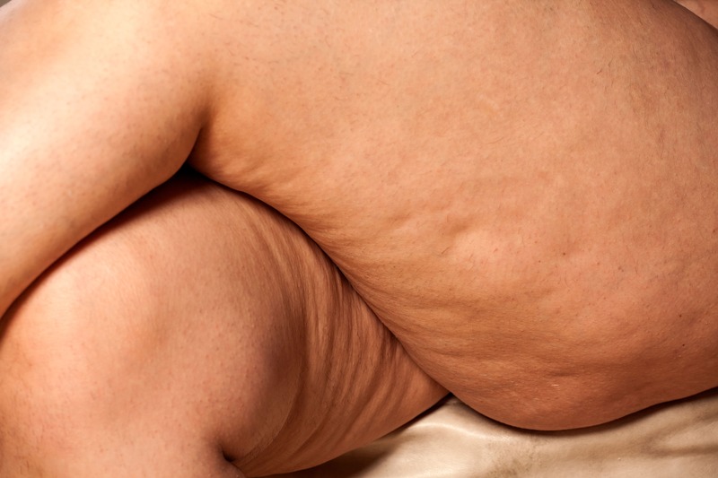 tipologie-cellulite-fibrosa
