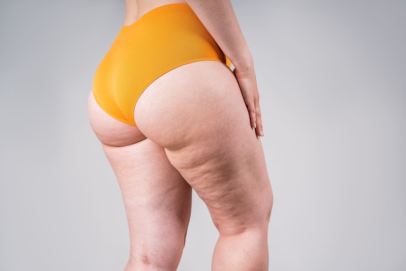 tipologie-cellulite-noduli