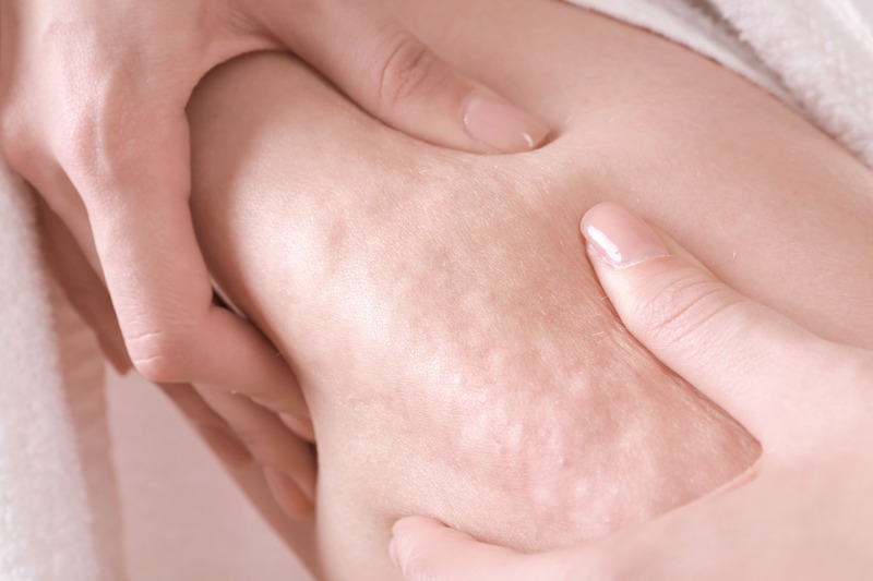 tipologie-cellulite-sclerotica