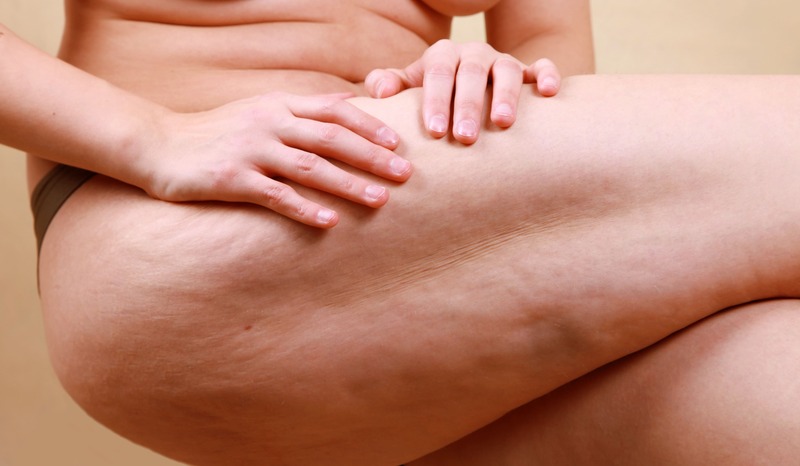 tipologie-cellulite-sclerotizzata