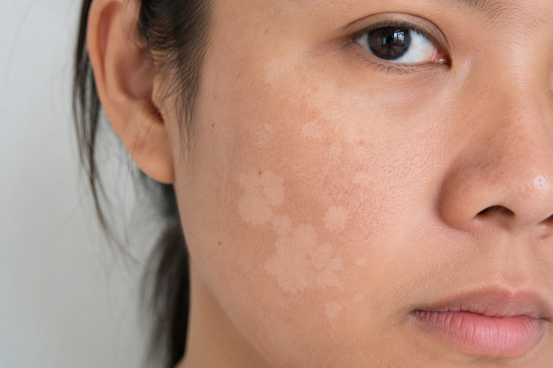abbronzatura-a-macchie-viso
