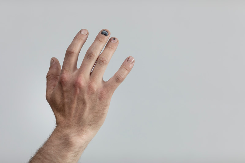 melanoma-unghie-mano