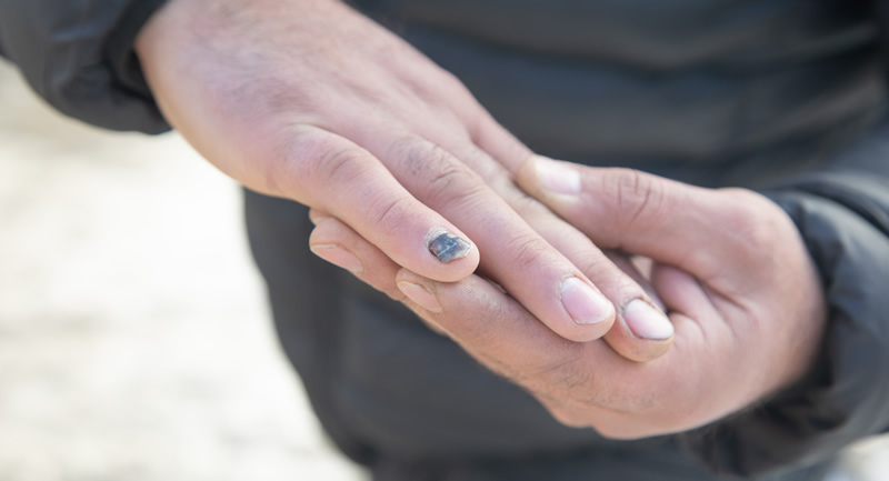 melanoma-unghie-mignolo