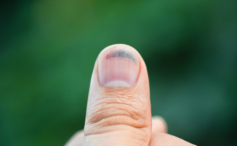 melanoma-unghie-nero