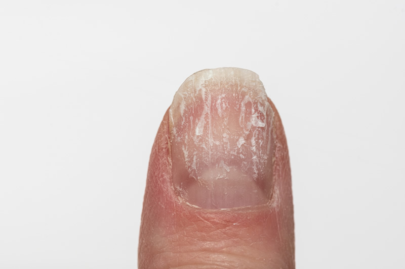 melanoma-unghie-striature