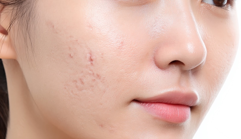 cliomakeup-come-usare-cicaplast-cicatrici