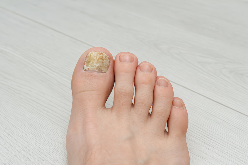 malattie-delle-unghie-alluce