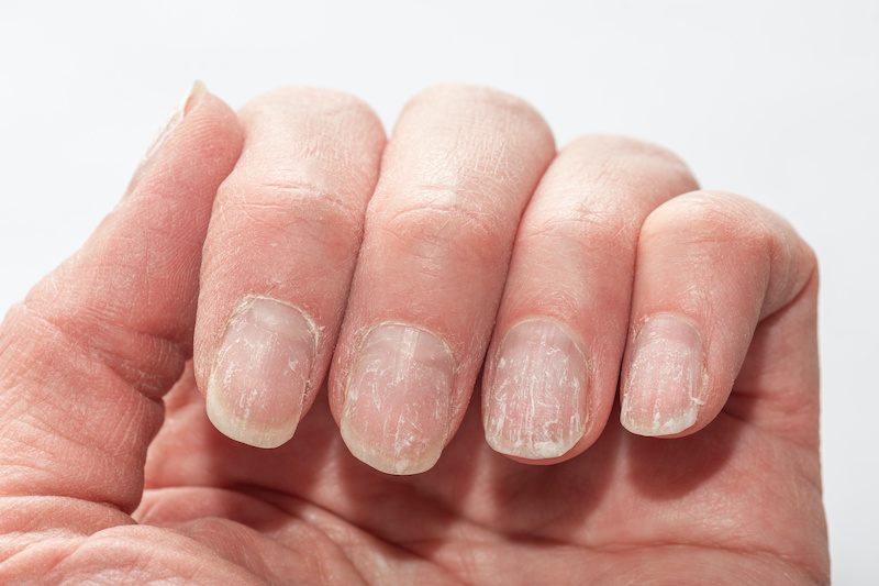 malattie-delle-unghie-rovinato