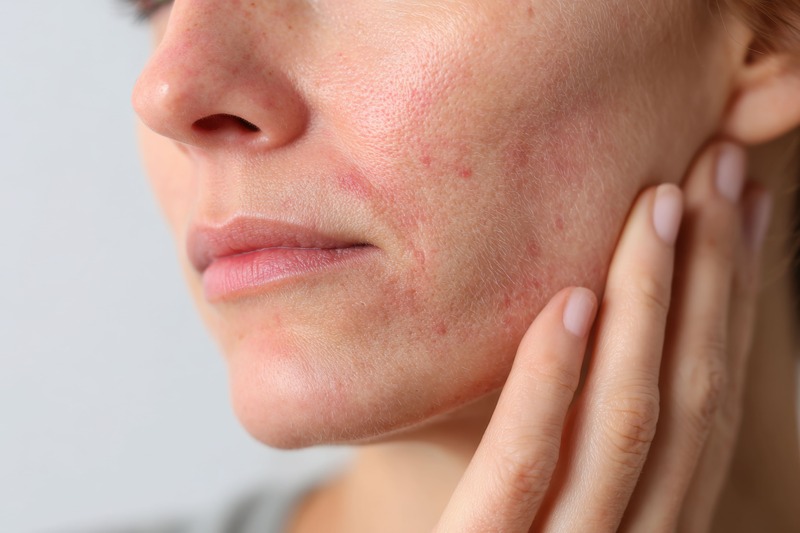 skincare-pelle-acneica-ormonale