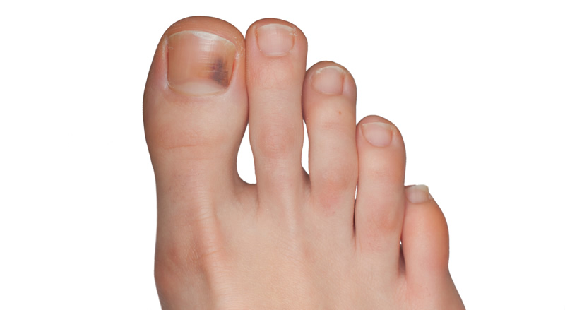 Unghie-piedi-nere-bianco