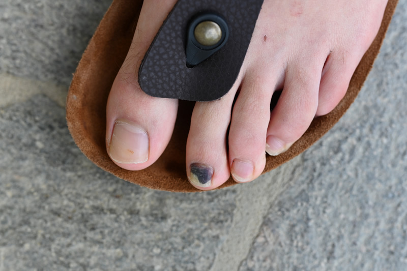 Unghie-piedi-nere-dito