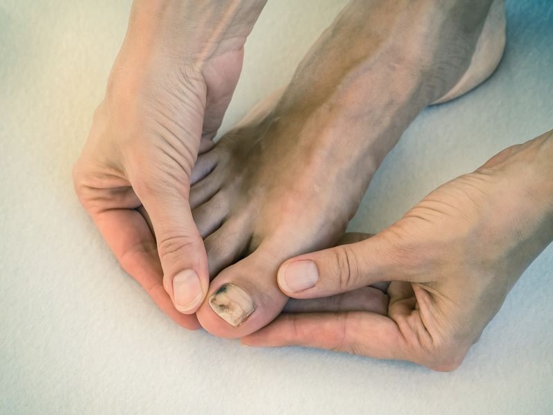 Unghie-piedi-nere-dolore