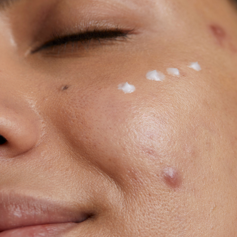 creme-acido-salicilico-acne