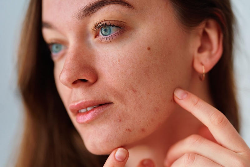 errori-comuni-skincare-brufoli