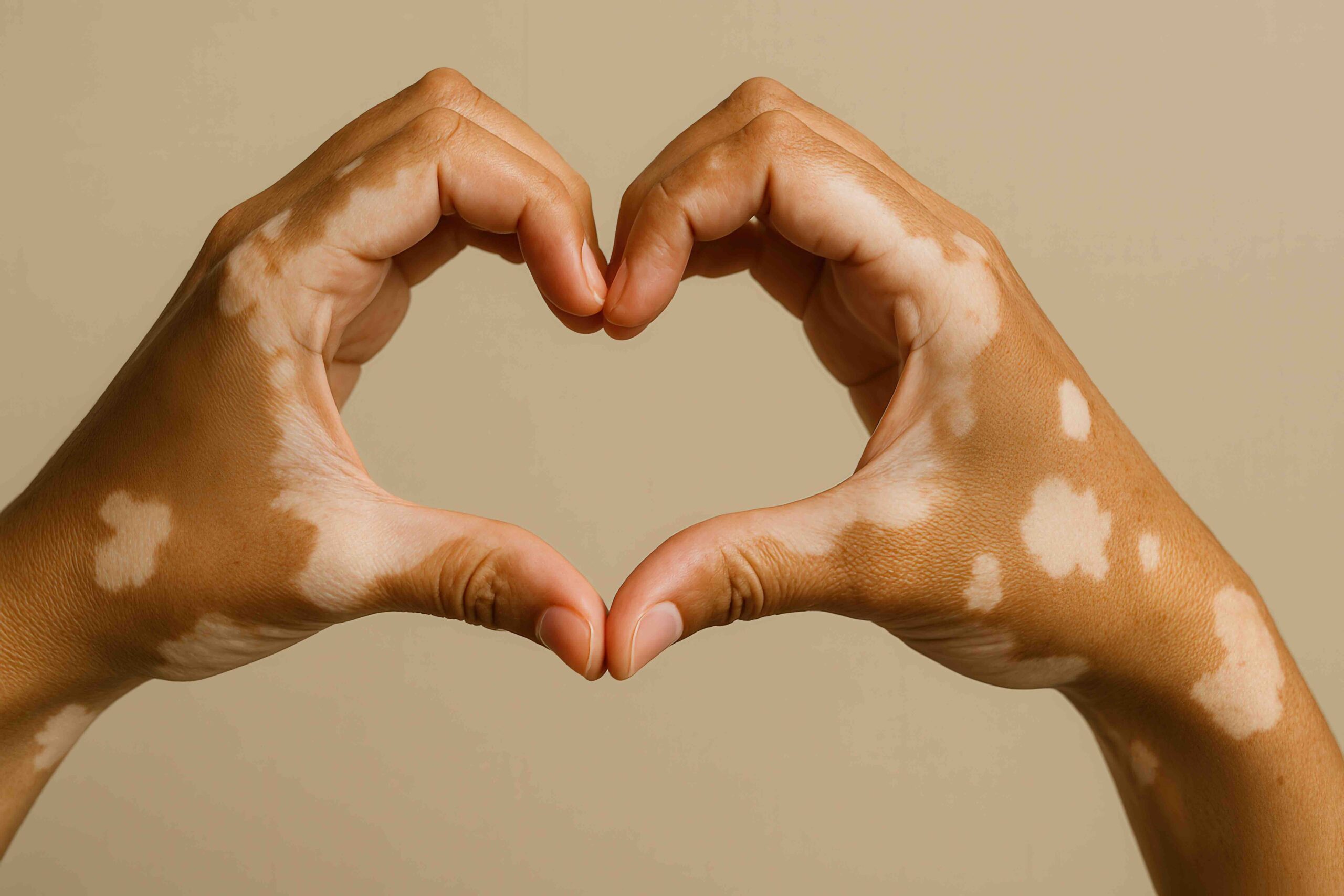 vitiligine-mani-cuore 