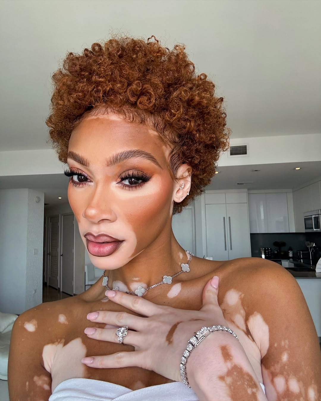 winnie-harlow-vitiligine