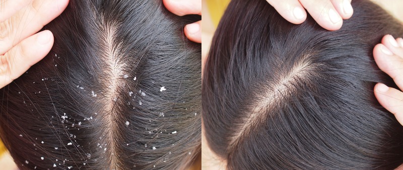 maschere-capelli-olio-cocco-desquamazione